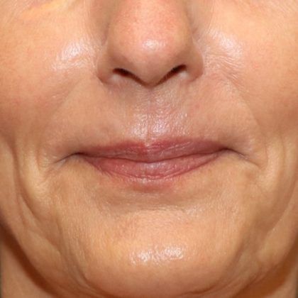 Lip Lift Before & After