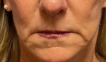 Lip Lift Before & After