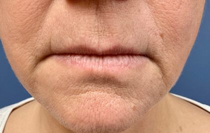 Lip Lift Before & After