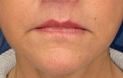 Lip Lift Before & After