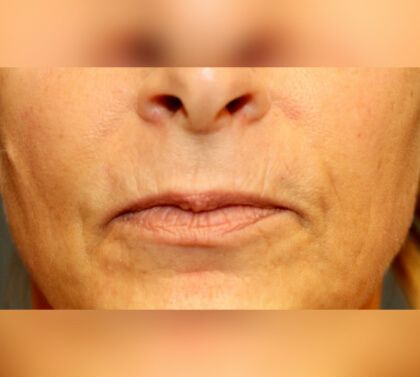 Lip Lift Before & After