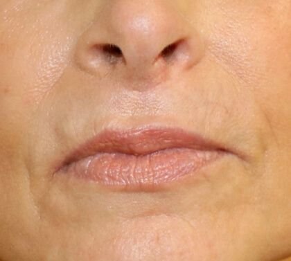 Lip Lift Before & After