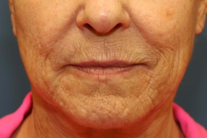 Lip Lift Before & After