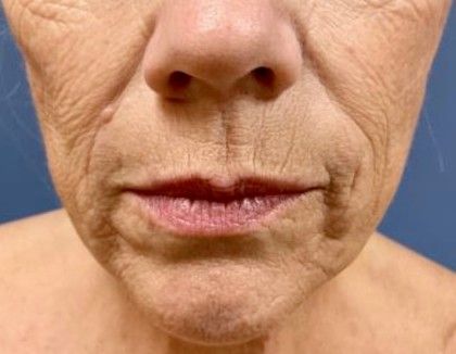 Lip Lift Before & After