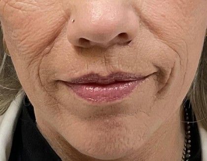 Lip Lift Before & After