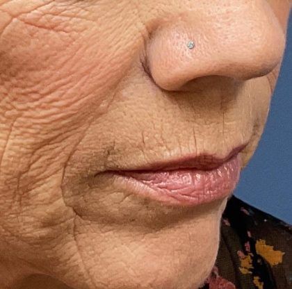 Lip Lift Before & After