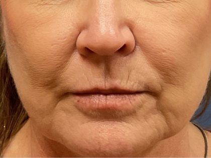 Lip Lift Before & After