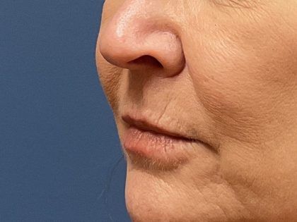 Lip Lift Before & After