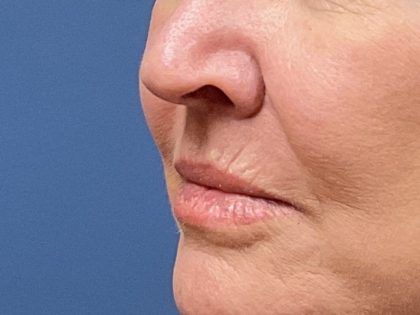 Lip Lift Before & After