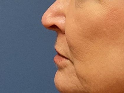 Lip Lift Before & After