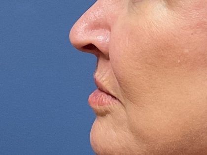 Lip Lift Before & After