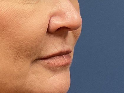 Lip Lift Before & After