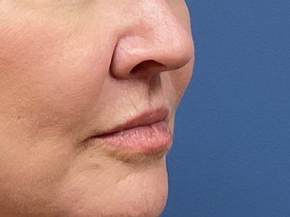 Lip Lift Before & After