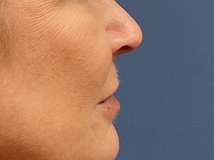 Lip Lift Before & After