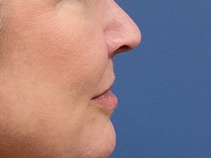 Lip Lift Before & After