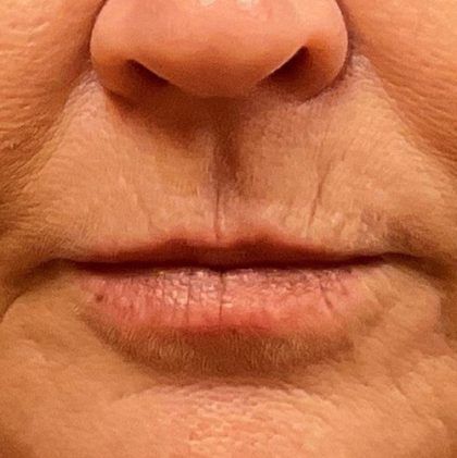 Lip Lift Before & After