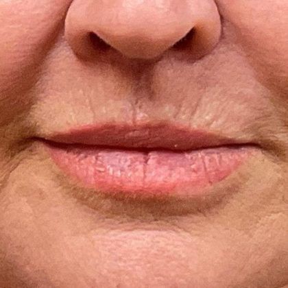 Lip Lift Before & After