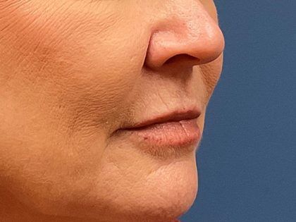 Lip Lift Before & After