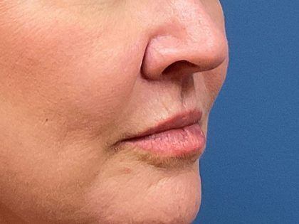 Lip Lift Before & After