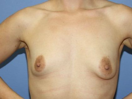 Tuberous Breast Correction Before & After