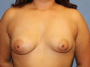 Tuberous Breast Correction Before & After