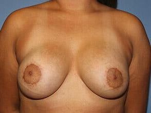 Tuberous Breast Correction Before & After