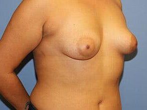Tuberous Breast Correction Before & After