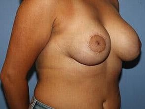 Tuberous Breast Correction Before & After
