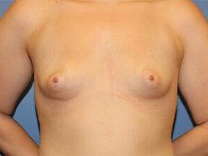 Tuberous Breast Correction Before & After