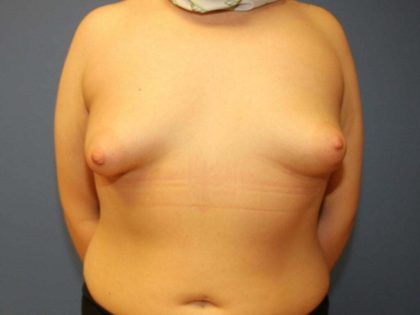 Tuberous Breast Correction Before & After