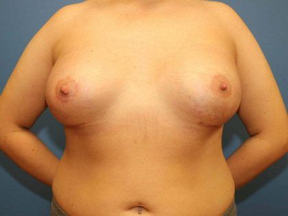 Tuberous Breast Correction Before & After