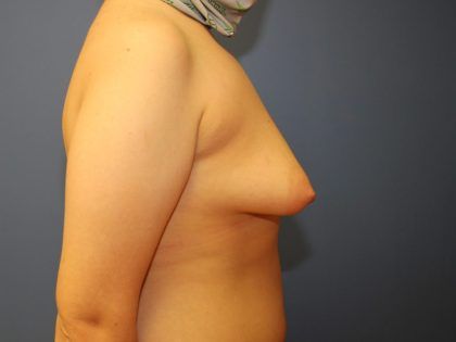 Tuberous Breast Correction Before & After