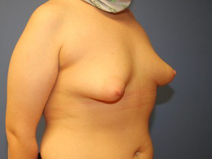 Tuberous Breast Correction Before & After