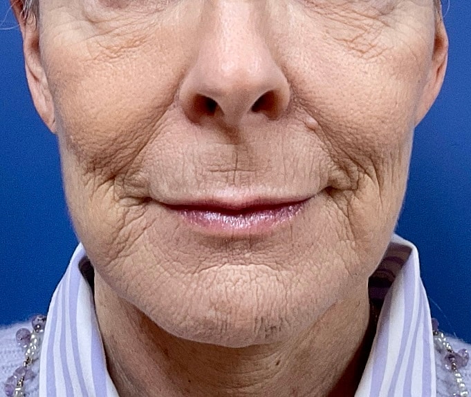 C02 Laser Resurfacing Before & After