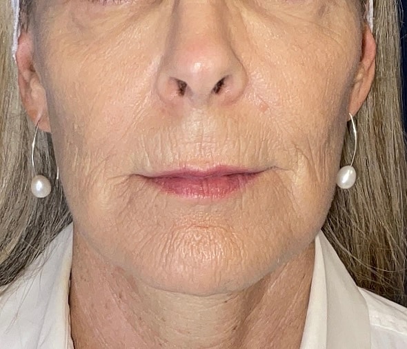 C02 Laser Resurfacing Before & After