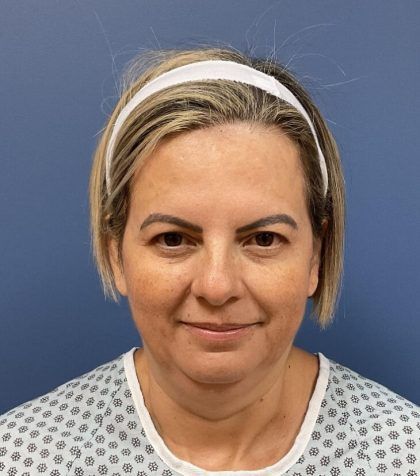 Facial Fat Transfer Before & After