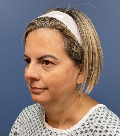 Facial Fat Transfer Before & After