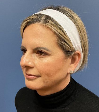 Facial Fat Transfer Before & After