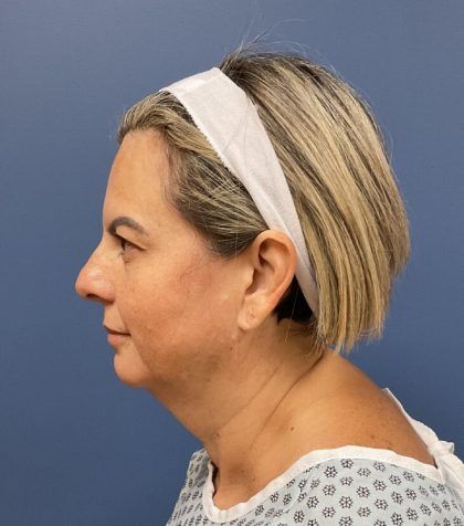 Facial Fat Transfer Before & After