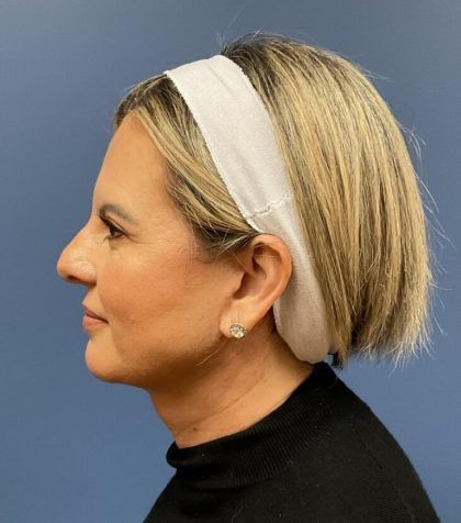 Facial Fat Transfer Before & After