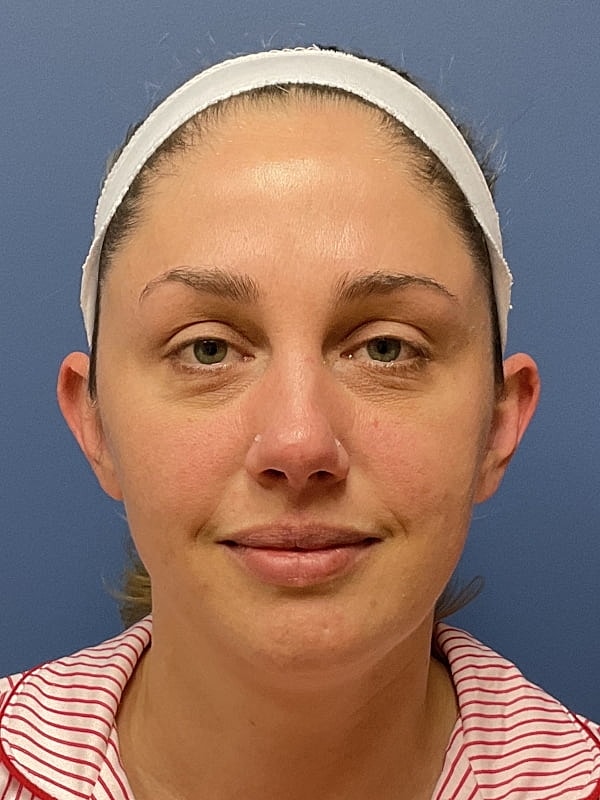 Facial Fat Transfer Before & After