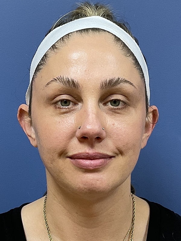 Facial Fat Transfer Before & After