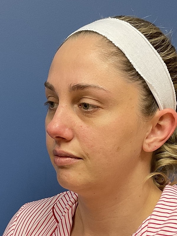 Facial Fat Transfer Before & After