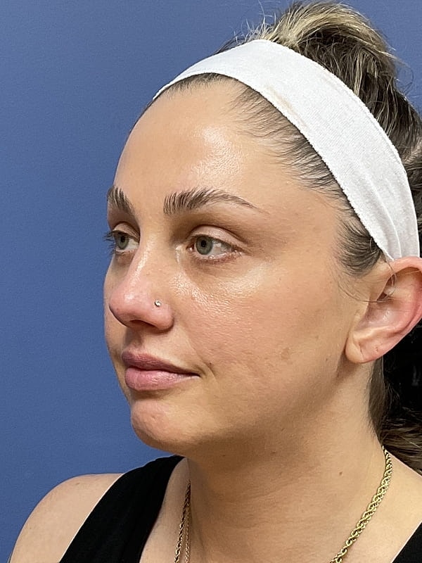 Facial Fat Transfer Before & After