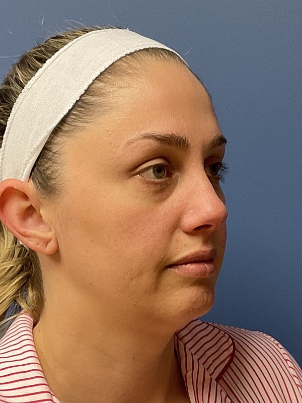 Facial Fat Transfer Before & After