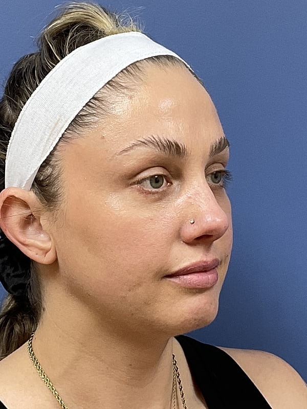 Facial Fat Transfer Before & After