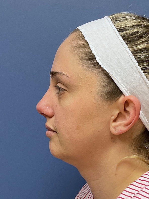 Facial Fat Transfer Before & After