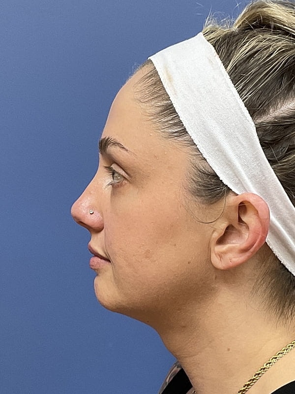 Facial Fat Transfer Before & After