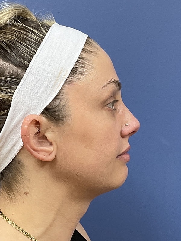 Facial Fat Transfer Before & After