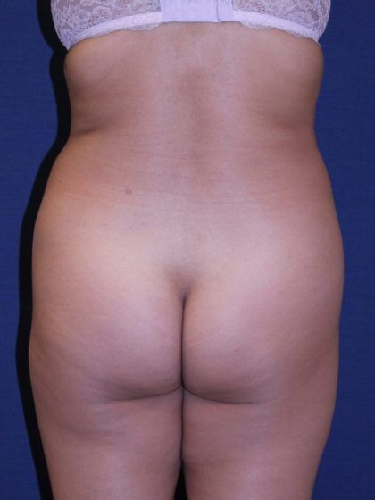 Brazilian Butt Lift Before & After